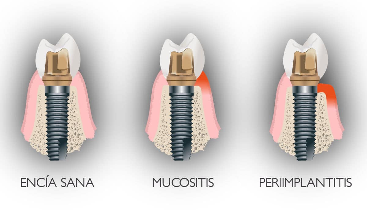 periimplantitis periimplantitis